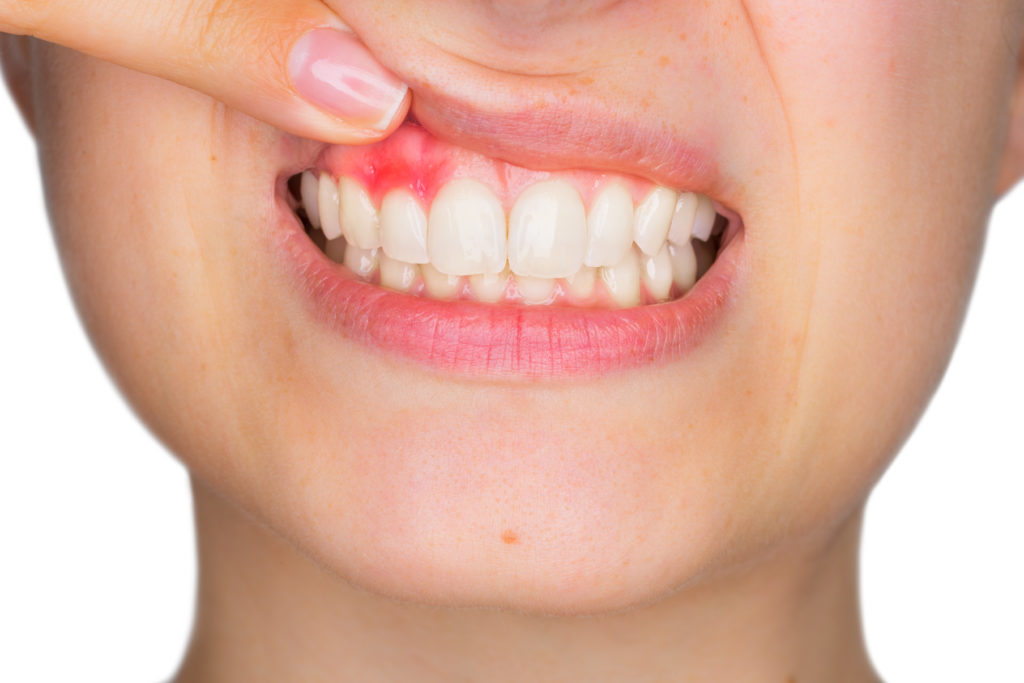 Warning Signs of Gum Disease