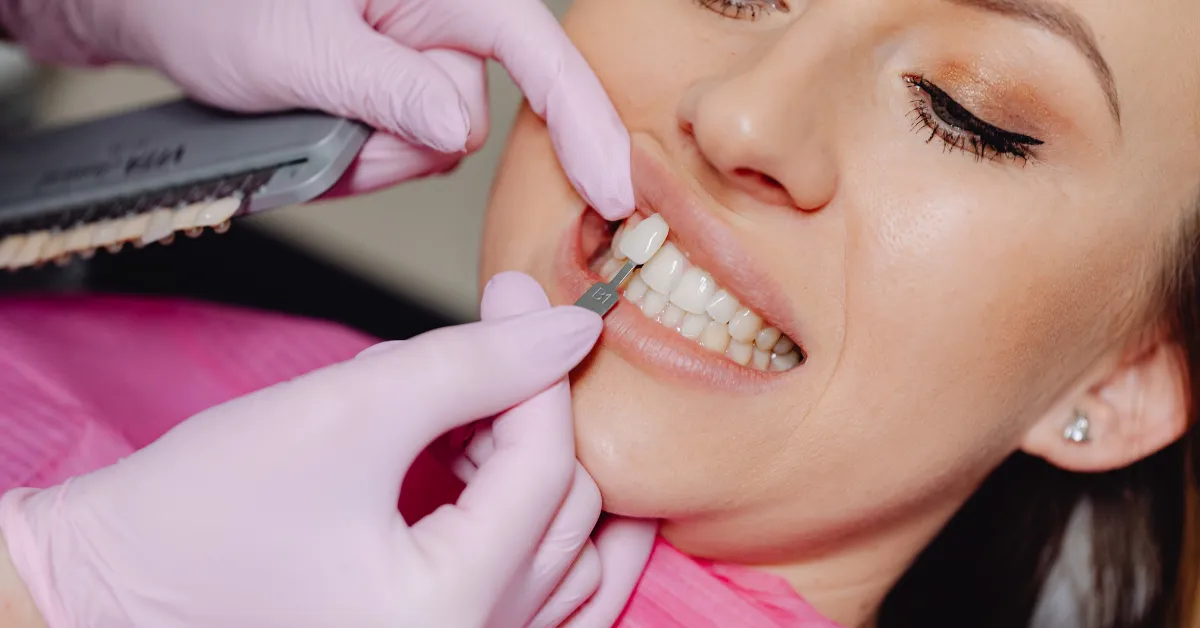 candidate for veneers