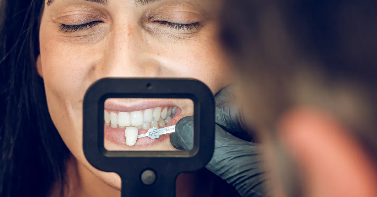 care for your dental veneers