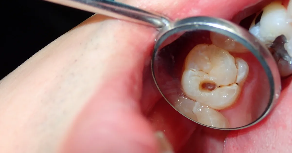 dental cavities