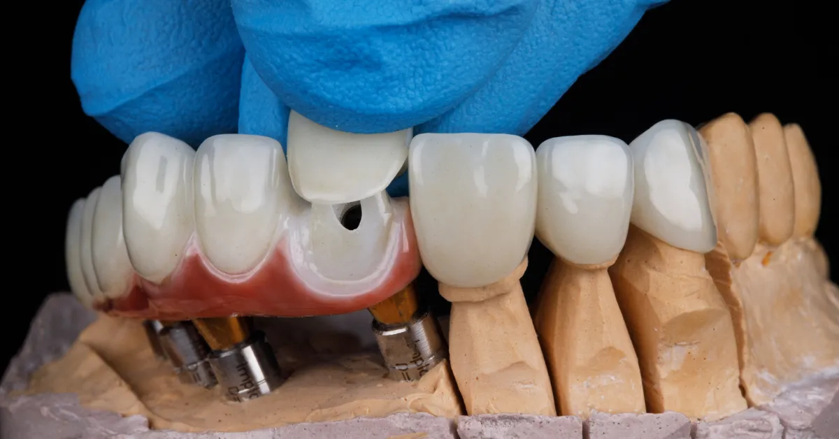 dental crown