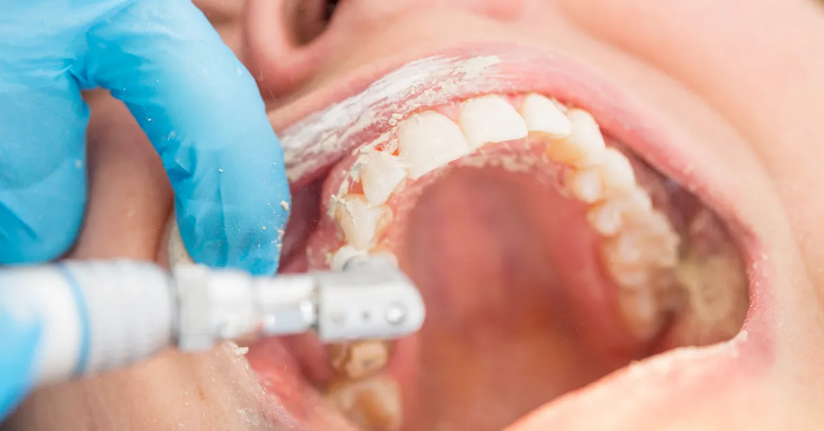 dental deep cleaning