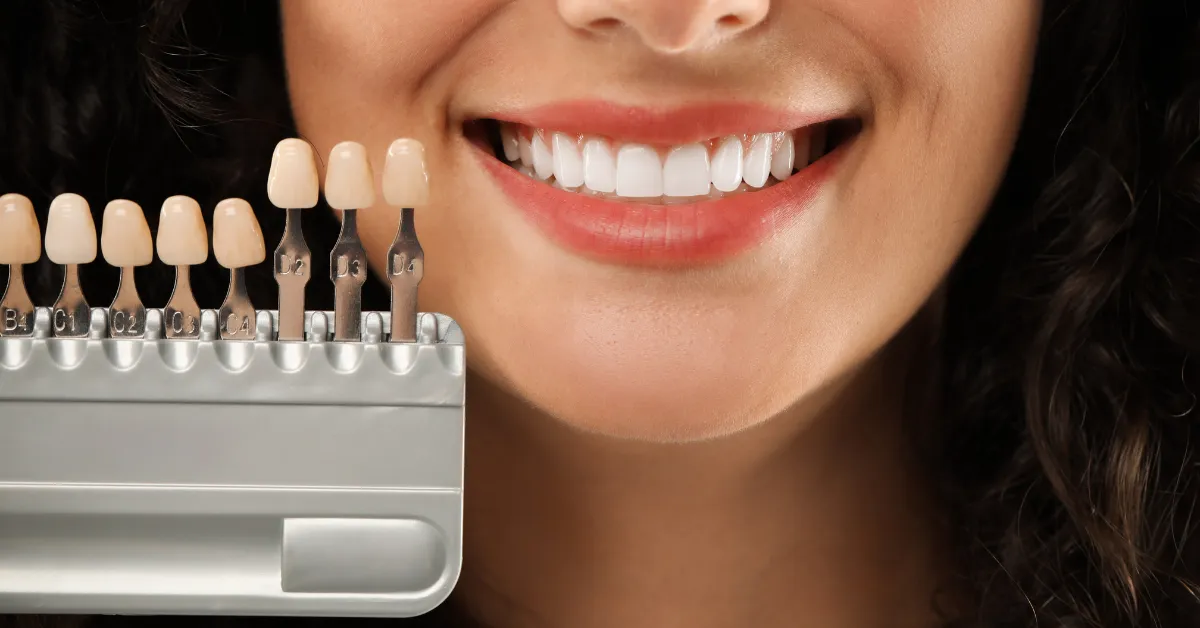 dental veneer process