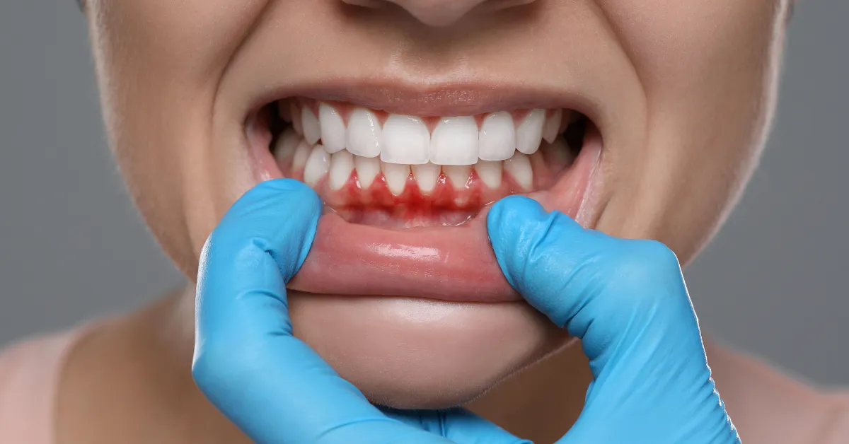 gum disease