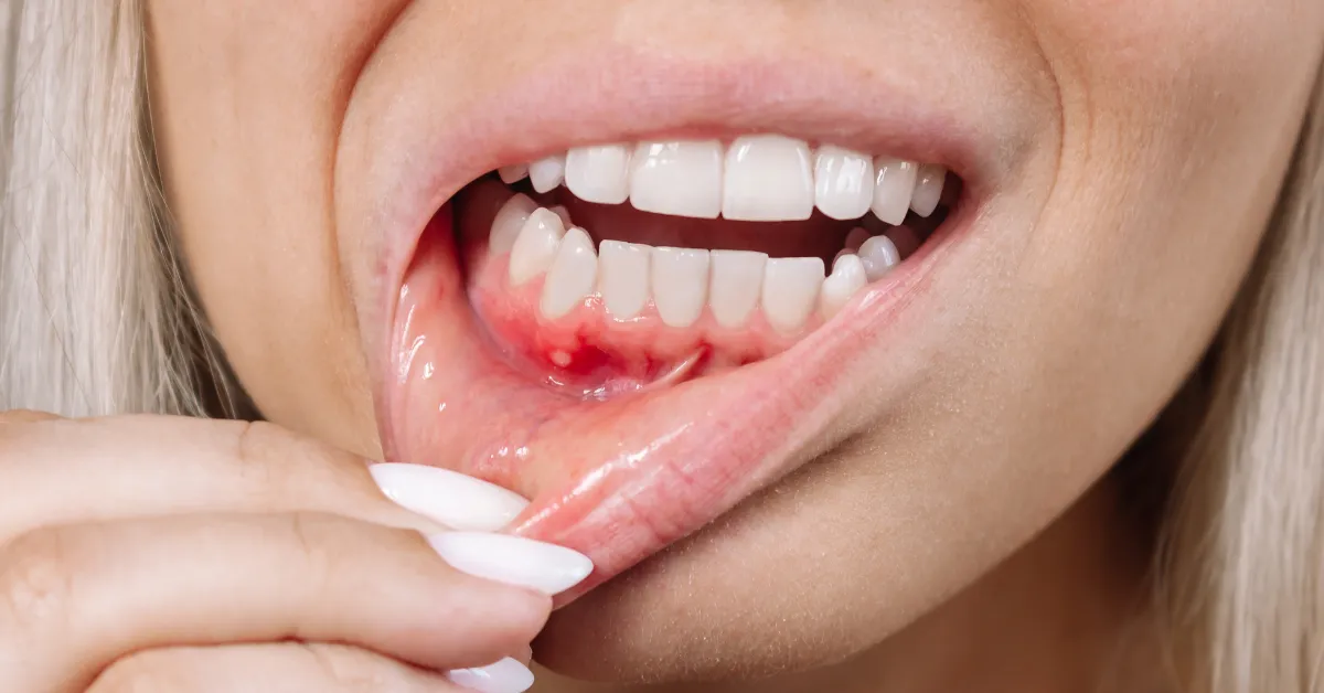 periodontitis