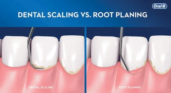 scaling and planing