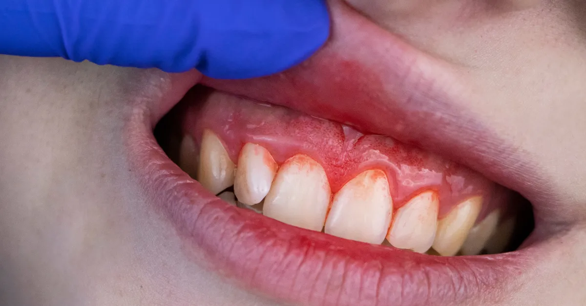 signs of gum disease