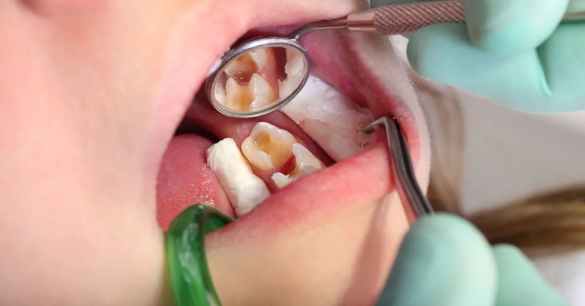 tooth fillings